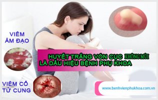 Huyết trắng bị vón cục như bã đậu là bị gì? làm sao chữa khỏi?