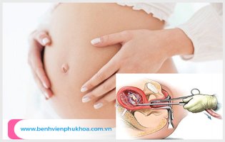 Phá thai bằng phương pháp kovax thực hiện ra sao