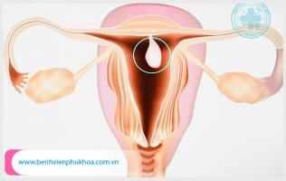 Polyp cổ tử cung có nguy hiểm không, điều trị ở đâu uy tín?