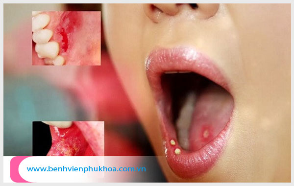 Giang mai ở miệng và lưỡi chỉ có thể hỗ trợ điều trị bằng thuốc