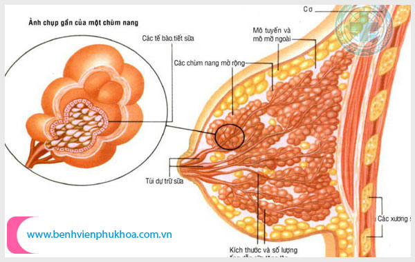 Hậu quả của u xơ tuyến vú là gì Hau-qua-cua-u-xo-tuyen-vu-la-gi-1