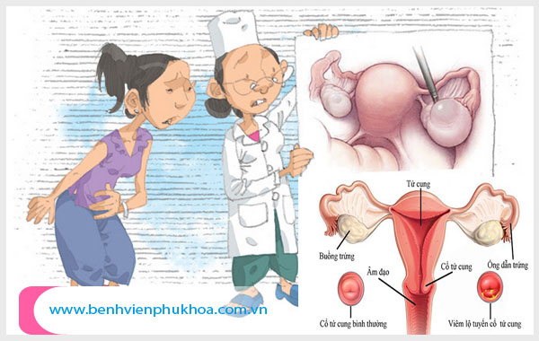 U xơ tử cung thường đến với táo bón và đau lưng