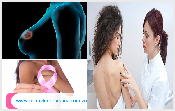 Siêu âm tuyến vú có ý nghĩa như thế nào trong tầm soát ung thư vú