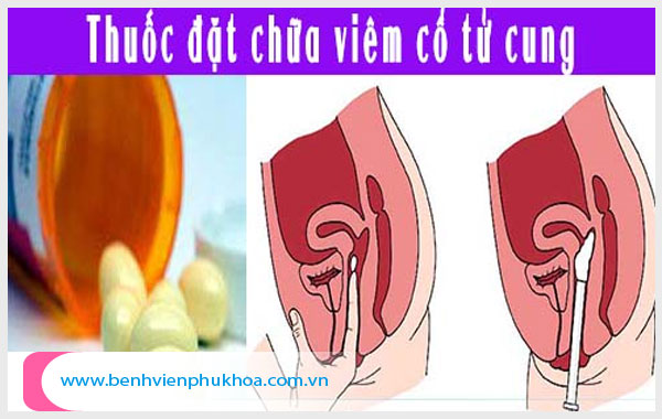 Viêm cổ tử cung là bệnh phụ khoa phổ biến nhất hiện nay