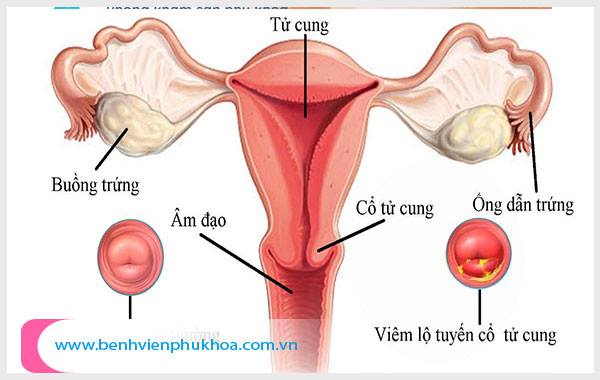 Viêm cổ tử cung cần thăm khám và điều trị sớm