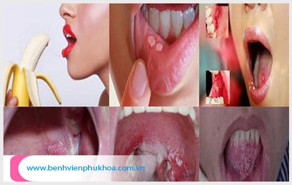 Quan hệ bằng miệng có nguy cơ mắc các bệnh xã hội nguy hiểm
