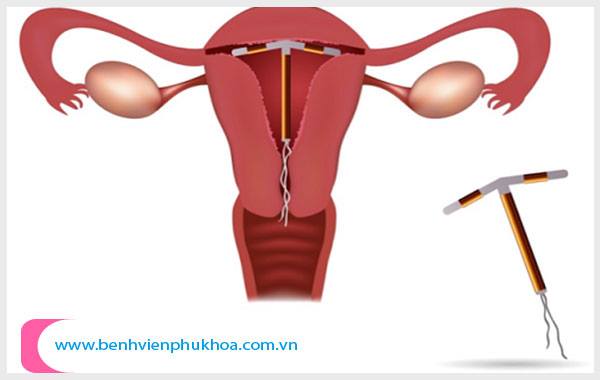 Vòng tránh thai được đặt trực tiếp bên trong tử cung